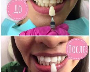 Студия косметического отбеливания зубов BeautySmile фото 2