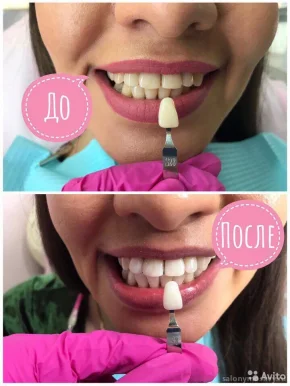 Студия косметического отбеливания зубов BeautySmile фото 2