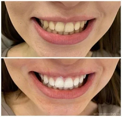 Студия косметического отбеливания зубов BeautySmile фото 1